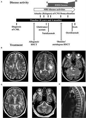 A Case of Multiple Sclerosis—Like Relapsing Remitting Encephalomyelitis Following Allogeneic Hematopoietic Stem Cell Transplantation and a Review of the Published Literature